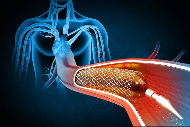 Interventional Cardiology